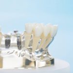 Niedoczynność tarczycy a implanty dentystyczne